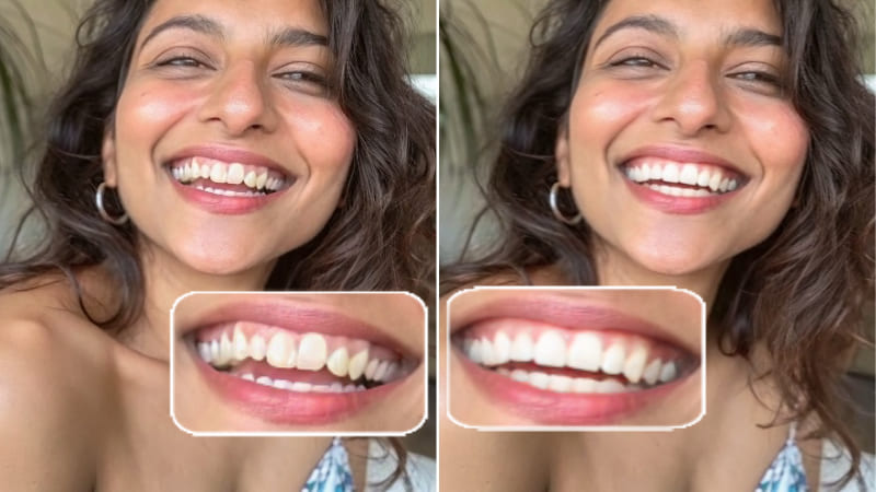 3 Best Straight Teeth Filters for the Perfect Smile